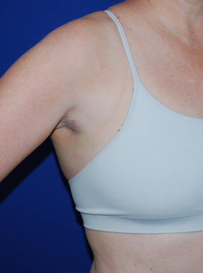 Liposuction Before & After Gallery - Patient 793488 - Image 2