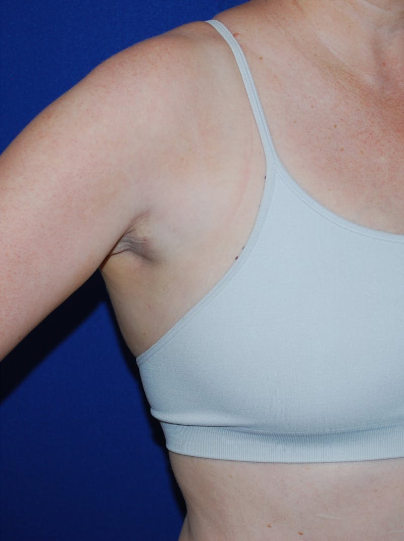 Liposuction Before & After Gallery - Patient 793488 - Image 2