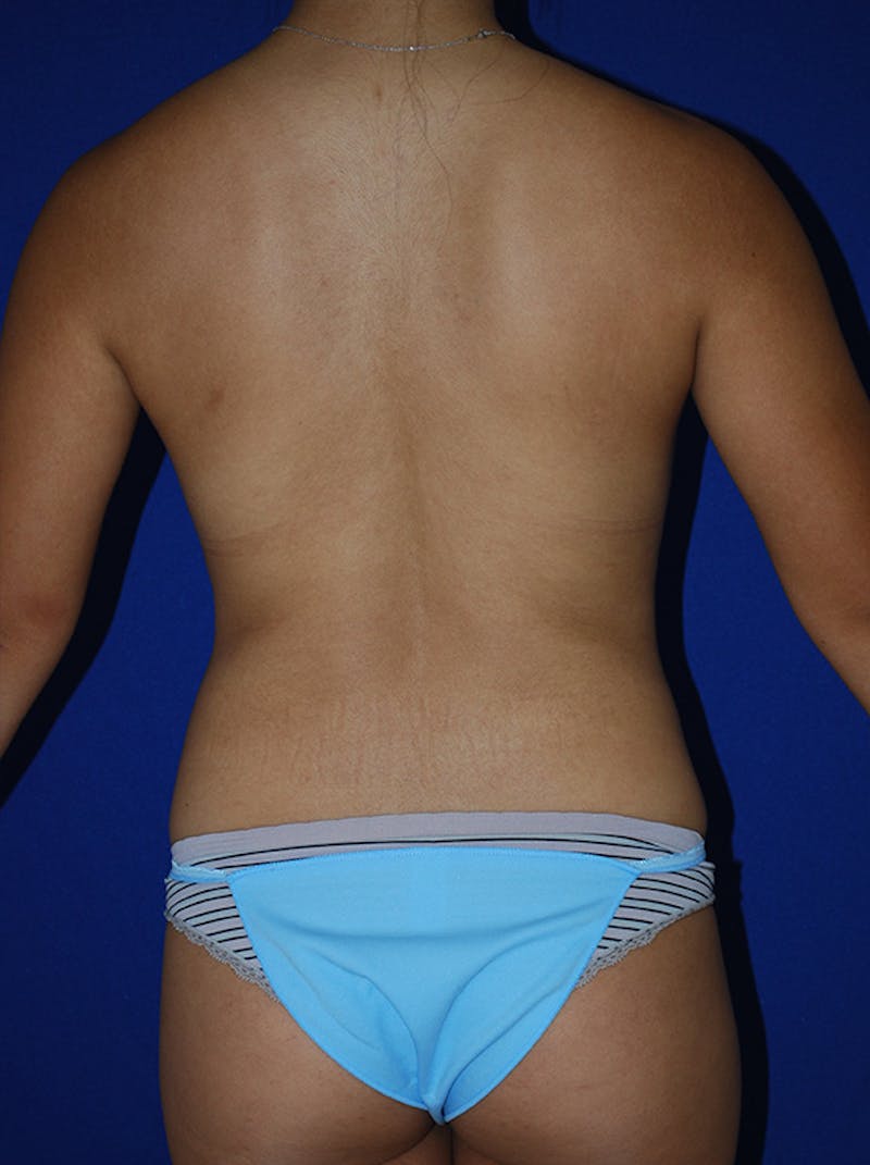 Liposuction Before & After Gallery - Patient 298853 - Image 7