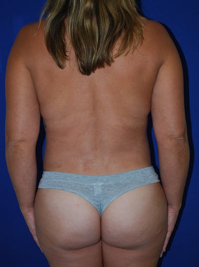 Liposuction Before & After Gallery - Patient 371226 - Image 2