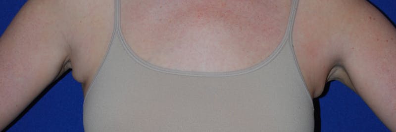 Liposuction Before & After Gallery - Patient 793488 - Image 5