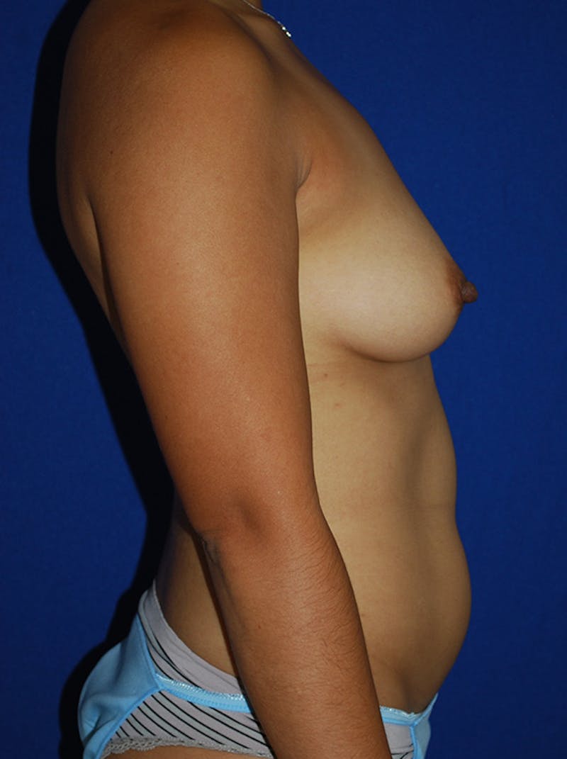 Liposuction Before & After Gallery - Patient 298853 - Image 3