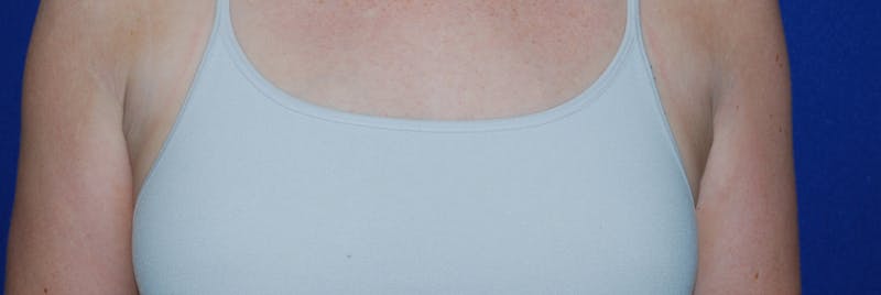 Liposuction Before & After Gallery - Patient 793488 - Image 4