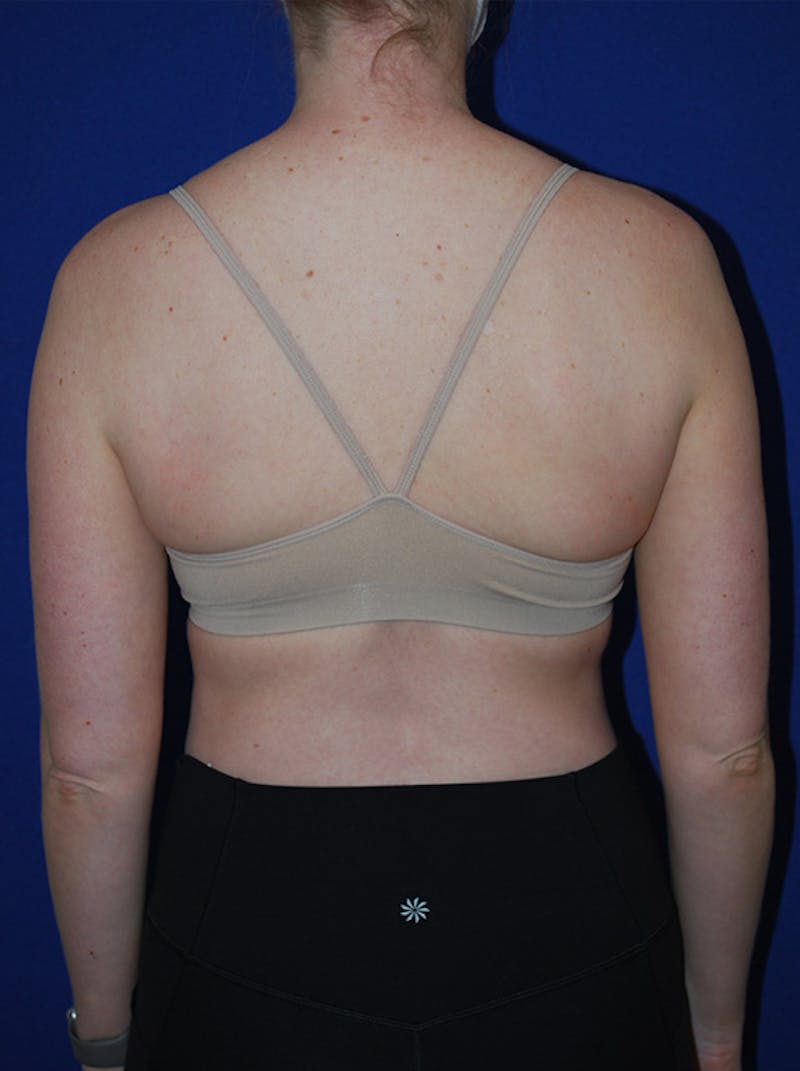 Liposuction Before & After Gallery - Patient 793488 - Image 7