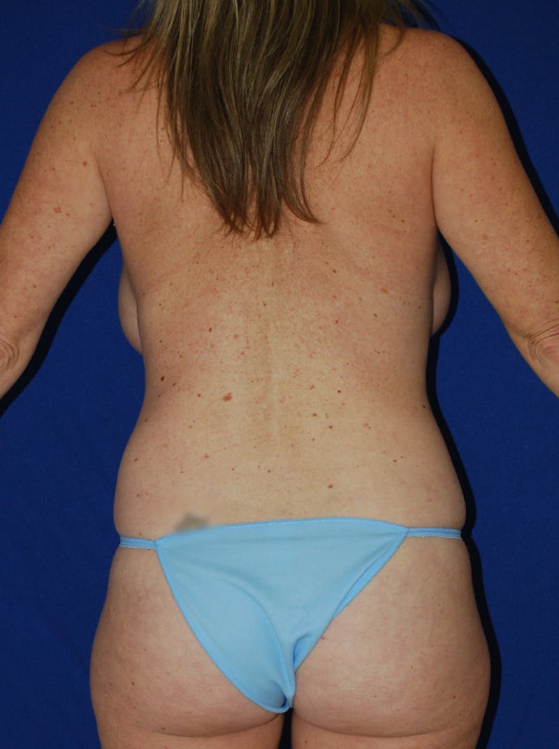 Liposuction Before & After Gallery - Patient 145763 - Image 1