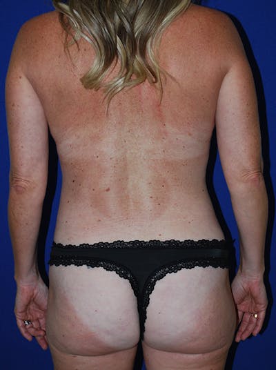 Liposuction Before & After Gallery - Patient 145763 - Image 2