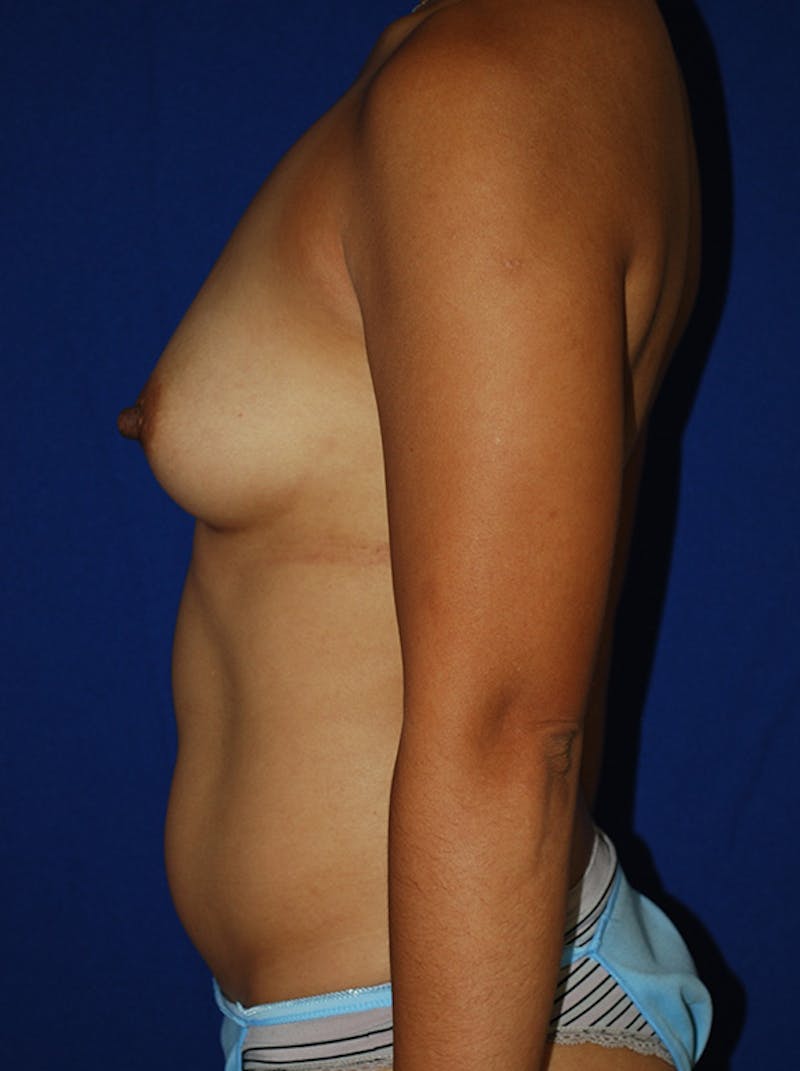 Liposuction Before & After Gallery - Patient 298853 - Image 5