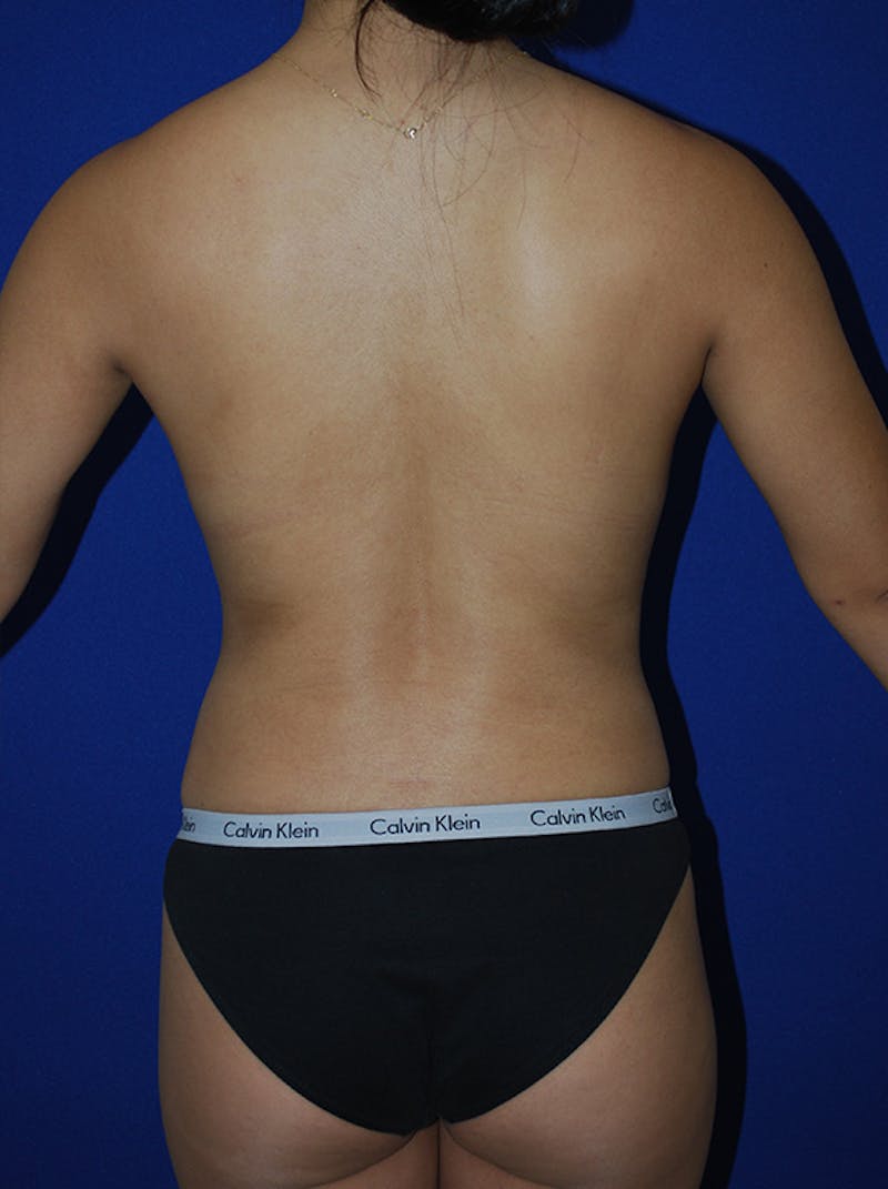 Liposuction Before & After Gallery - Patient 298853 - Image 8