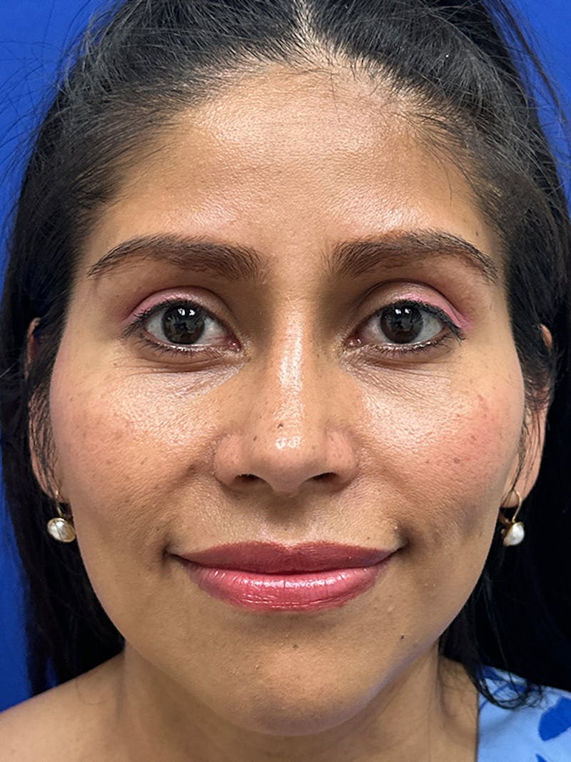 Rhinoplasty Before & After Gallery - Patient 229799 - Image 4