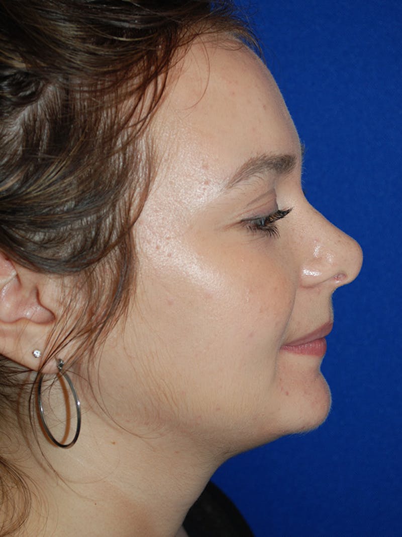 Rhinoplasty Before & After Gallery - Patient 335247 - Image 6