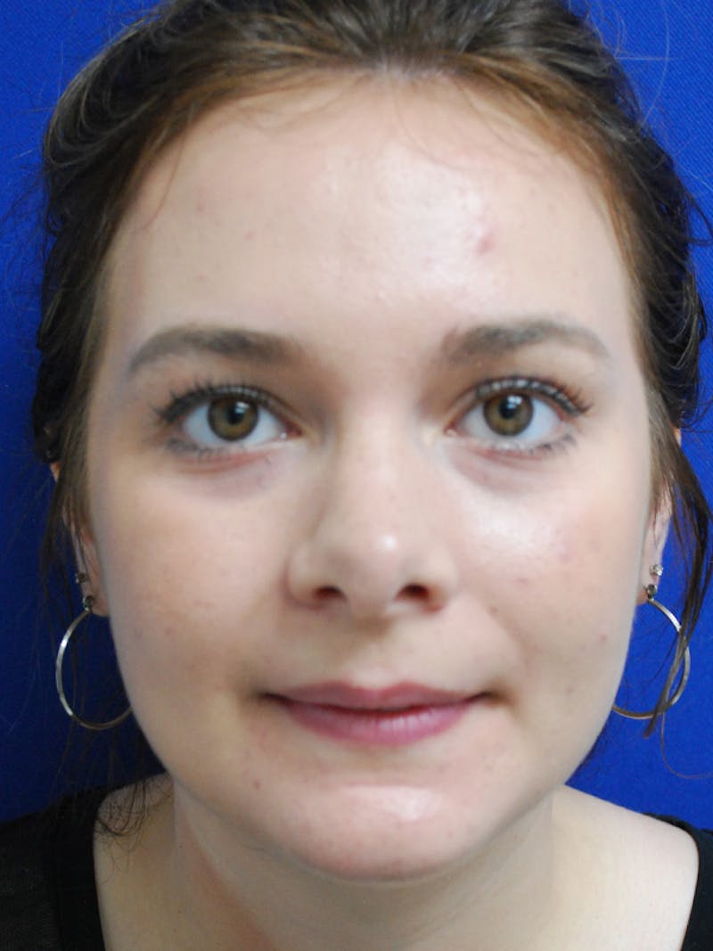Rhinoplasty Before & After Gallery - Patient 335247 - Image 4