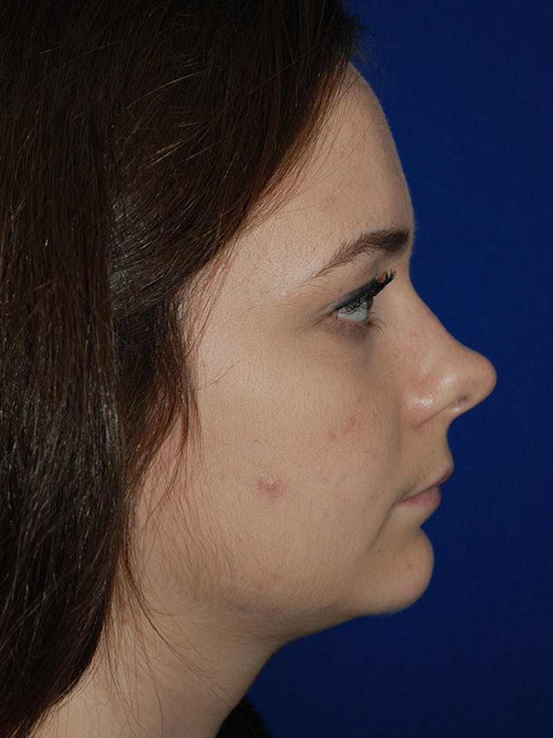 Rhinoplasty Before & After Gallery - Patient 335247 - Image 5