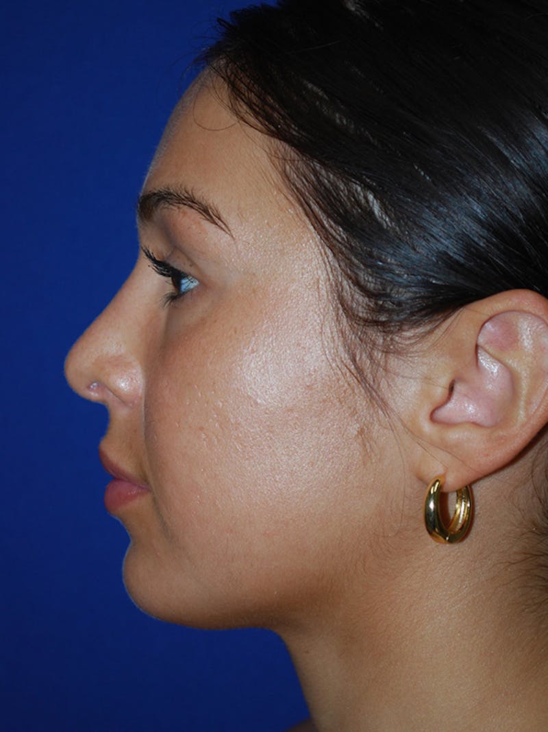 Rhinoplasty Before & After Gallery - Patient 355778 - Image 2