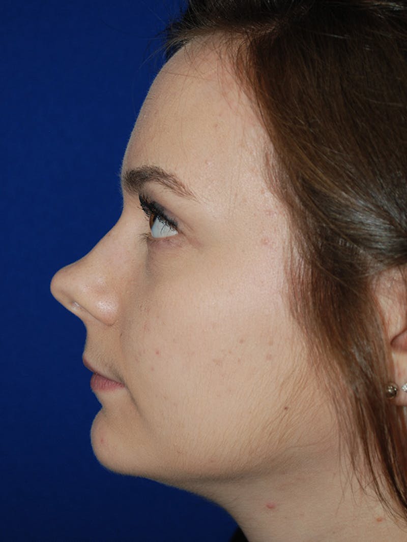 Rhinoplasty Before & After Gallery - Patient 335247 - Image 1