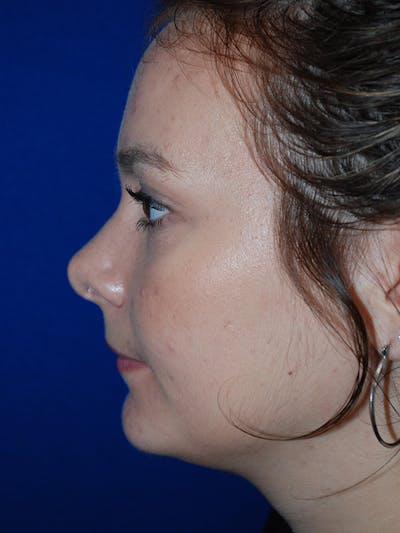 Rhinoplasty Before & After Gallery - Patient 335247 - Image 2