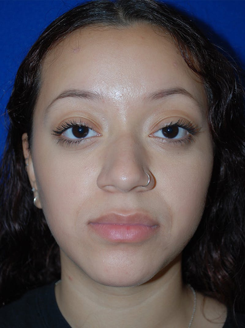 Rhinoplasty Before & After Gallery - Patient 355778 - Image 3