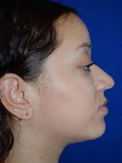 Rhinoplasty Before & After Gallery - Patient 355778 - Image 1