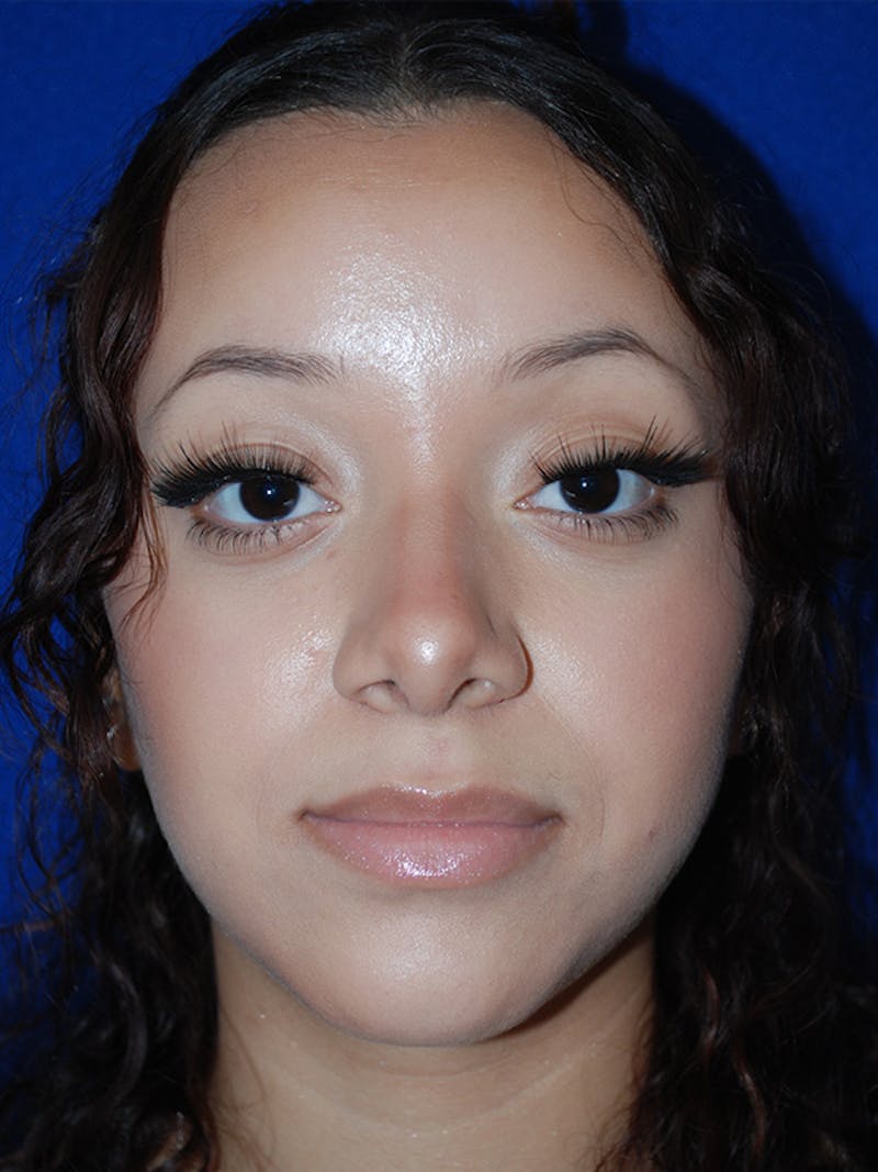 Rhinoplasty Before & After Gallery - Patient 355778 - Image 4