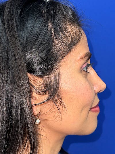 Rhinoplasty Before & After Gallery - Patient 229799 - Image 2