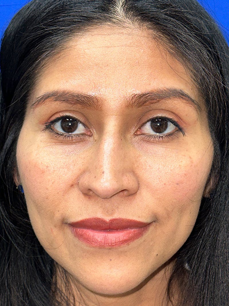 Rhinoplasty Before & After Gallery - Patient 229799 - Image 3