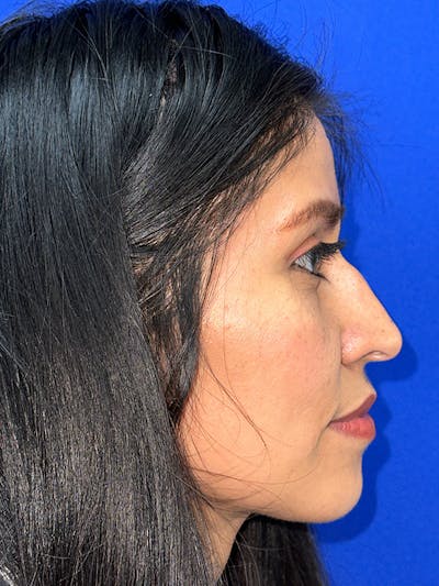 Rhinoplasty Before & After Gallery - Patient 229799 - Image 1