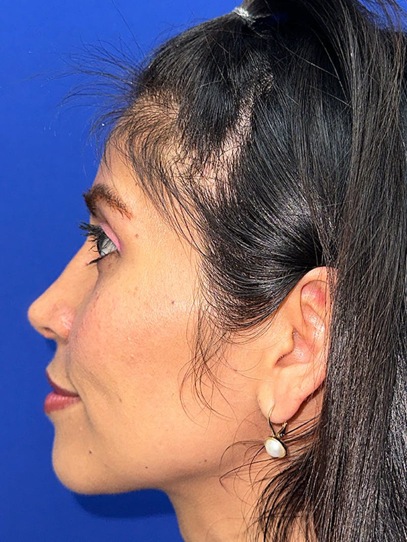 Rhinoplasty Before & After Gallery - Patient 229799 - Image 6