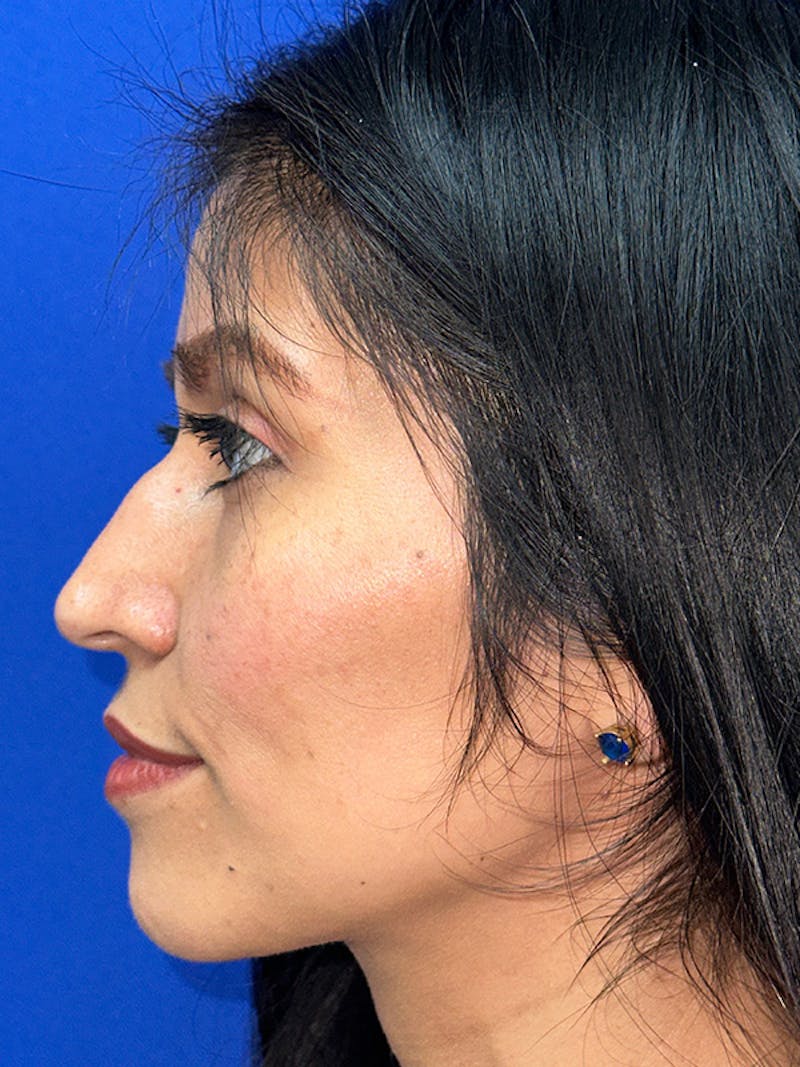 Rhinoplasty Before & After Gallery - Patient 229799 - Image 5