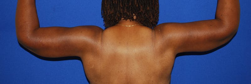 Brachioplasty Before & After Gallery - Patient 175174014 - Image 4