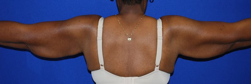 Brachioplasty Before & After Gallery - Patient 175174014 - Image 5