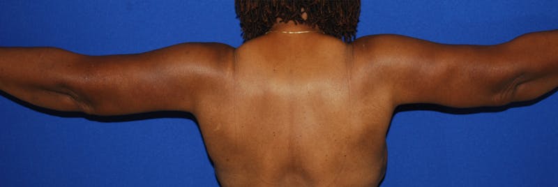 Brachioplasty Before & After Gallery - Patient 175174014 - Image 6
