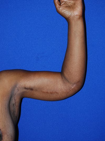 Brachioplasty Before & After Gallery - Patient 175174014 - Image 2