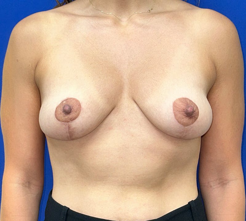 Mastopexy/Lift Before & After Gallery - Patient 424989 - Image 2