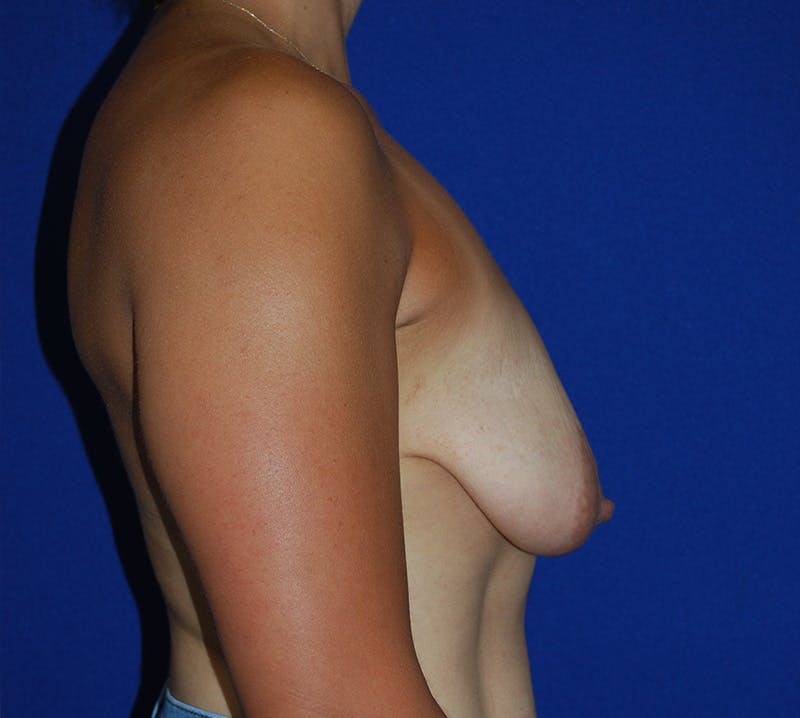 Mastopexy/Lift Before & After Gallery - Patient 424989 - Image 3