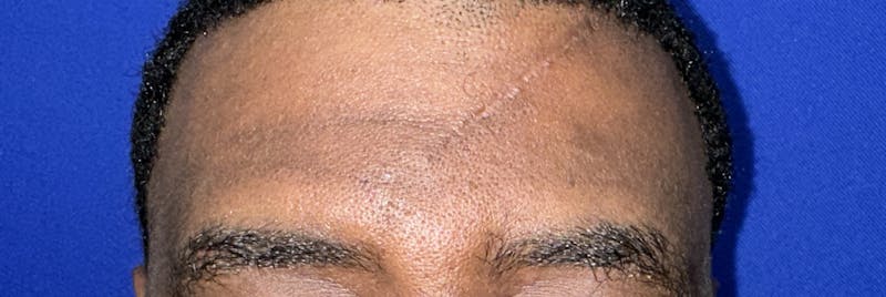 Tissue Excision Before & After Gallery - Patient 335944 - Image 4
