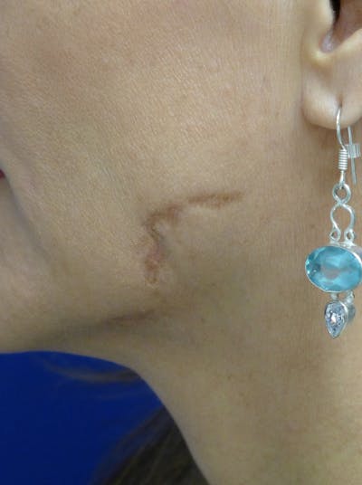 Tissue Excision Before & After Gallery - Patient 334174 - Image 1