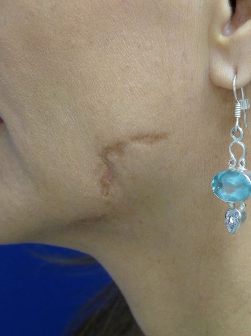 Tissue Excision Before & After Gallery - Patient 334174 - Image 1