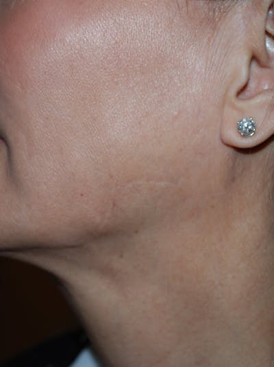 Tissue Excision Before & After Gallery - Patient 334174 - Image 2