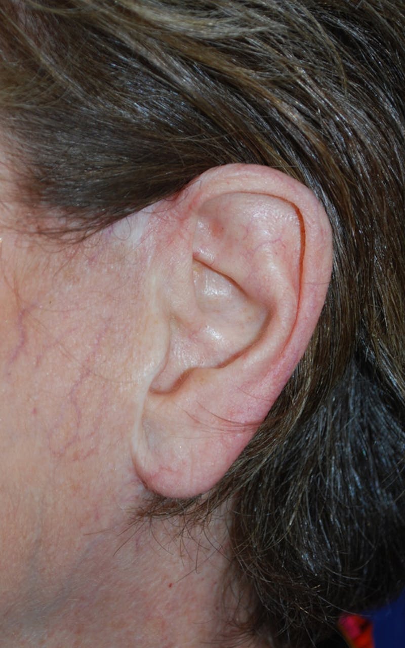 Tissue Excision Before & After Gallery - Patient 298182 - Image 4