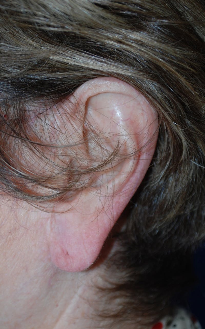 Tissue Excision Before & After Gallery - Patient 298182 - Image 3