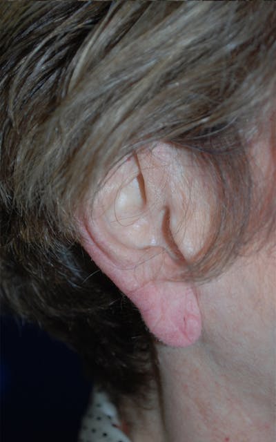 Tissue Excision Before & After Gallery - Patient 298182 - Image 1