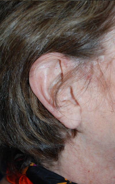 Tissue Excision Before & After Gallery - Patient 298182 - Image 2
