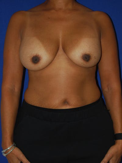 Augmentation Mastopexy Before & After Gallery - Patient 236017 - Image 1