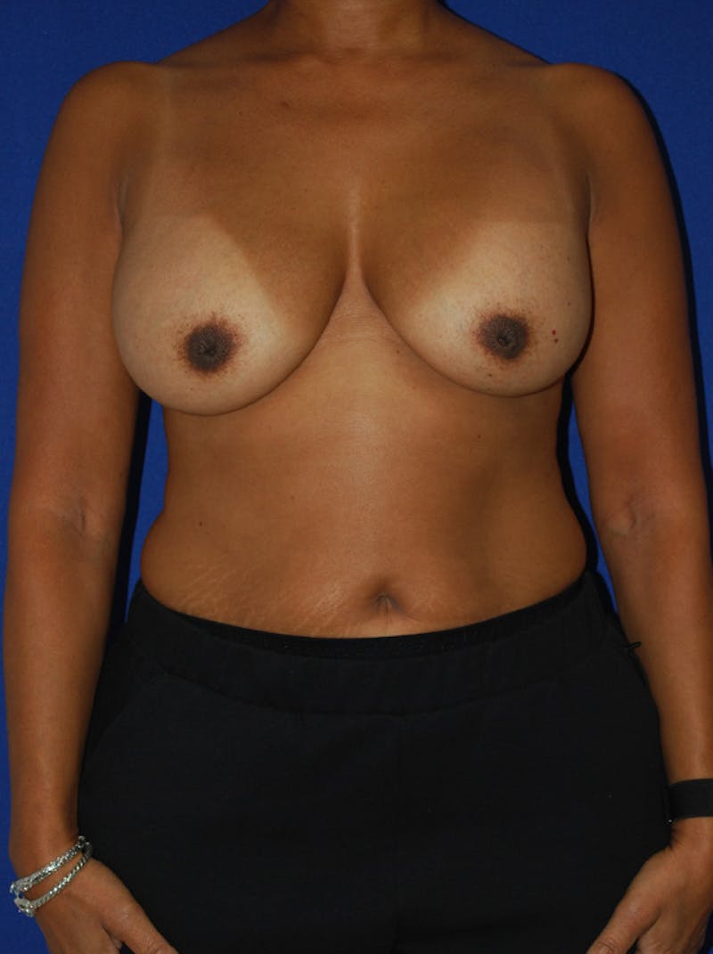 Augmentation Mastopexy Before & After Gallery - Patient 236017 - Image 1