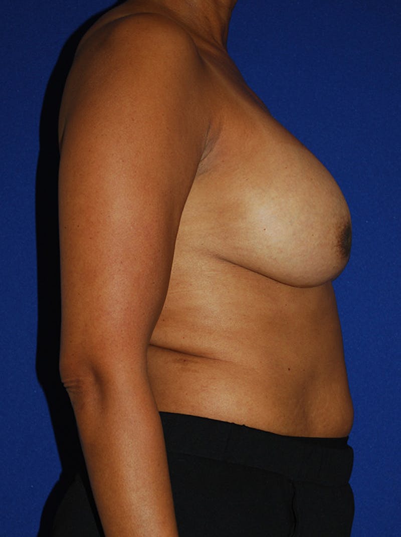 Augmentation Mastopexy Before & After Gallery - Patient 236017 - Image 3