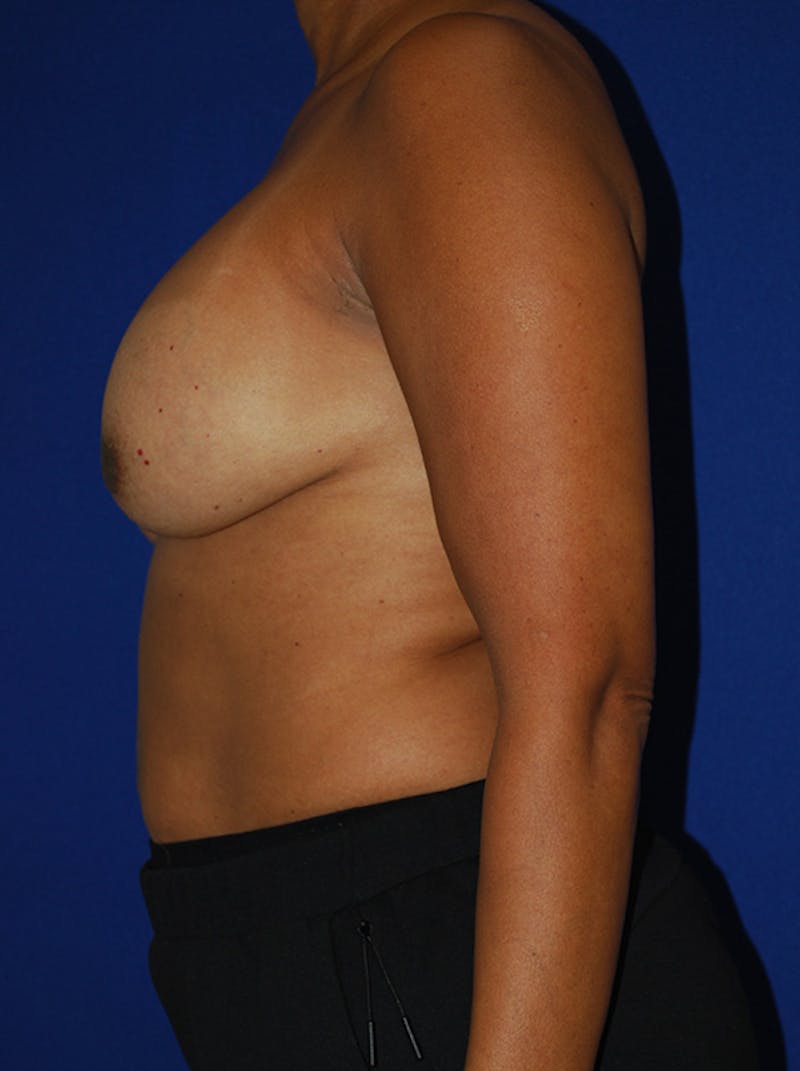 Augmentation Mastopexy Before & After Gallery - Patient 236017 - Image 5