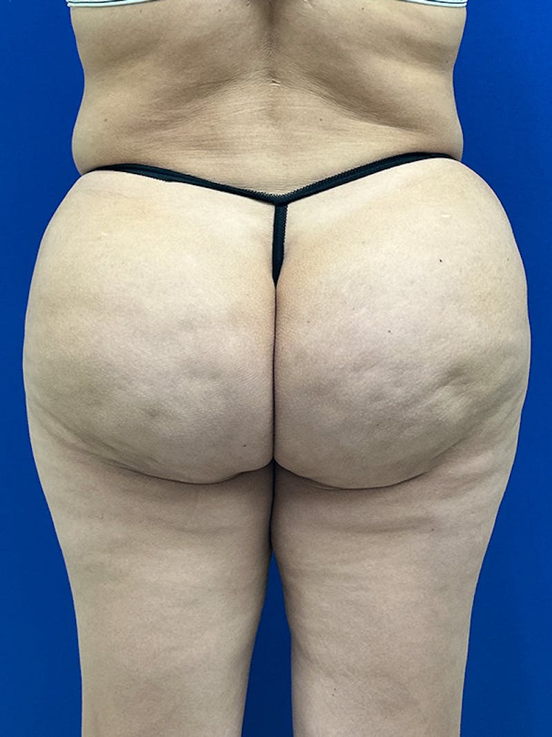 Avéli Cellulite Treatment Before & After Gallery - Patient 427458 - Image 4