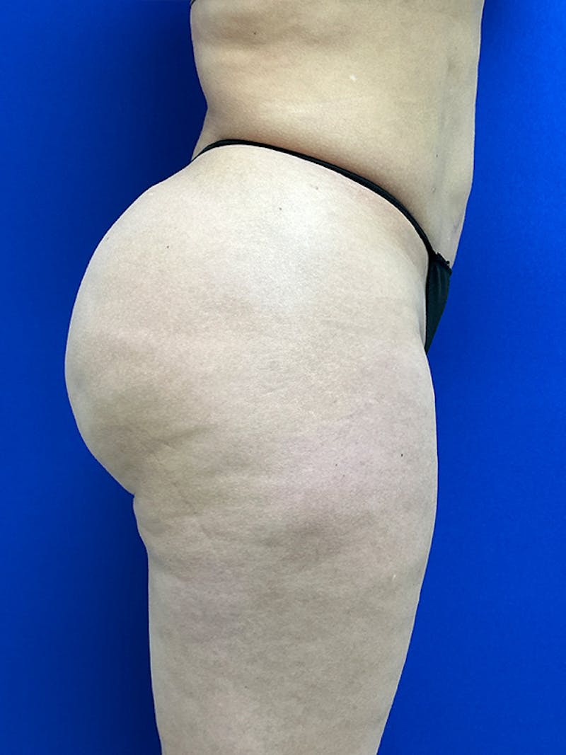 Avéli Cellulite Treatment Before & After Gallery - Patient 427458 - Image 7