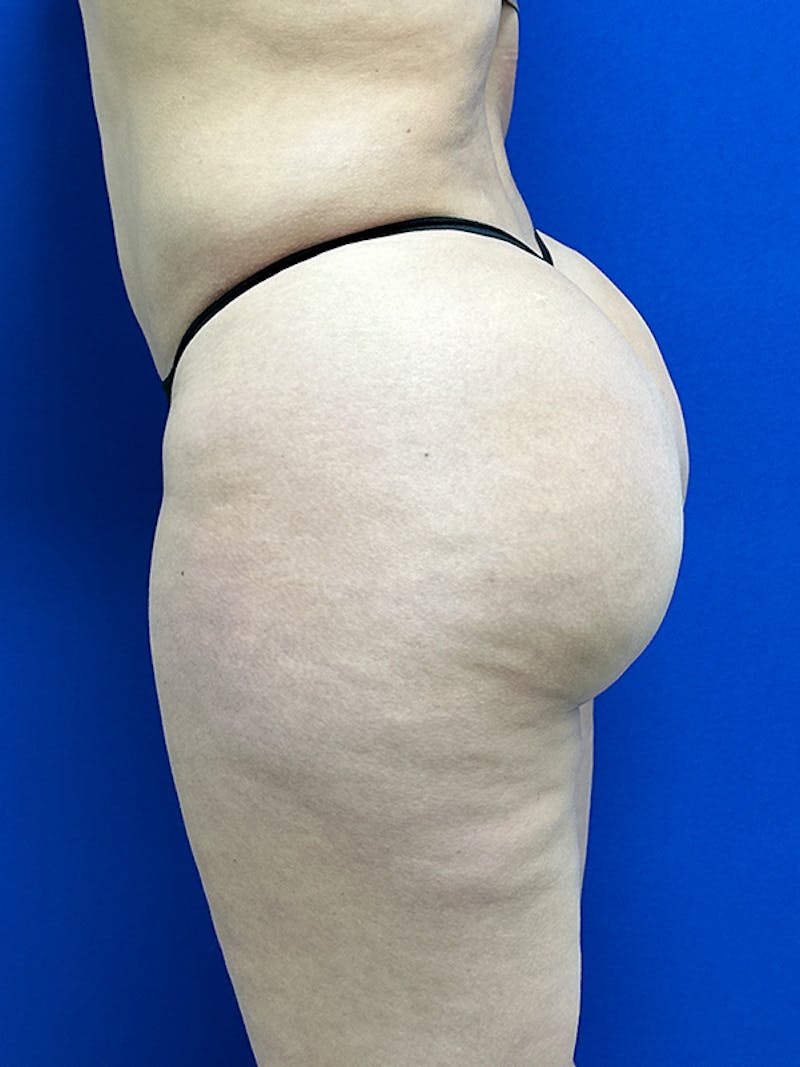 Avéli Cellulite Treatment Before & After Gallery - Patient 427458 - Image 11