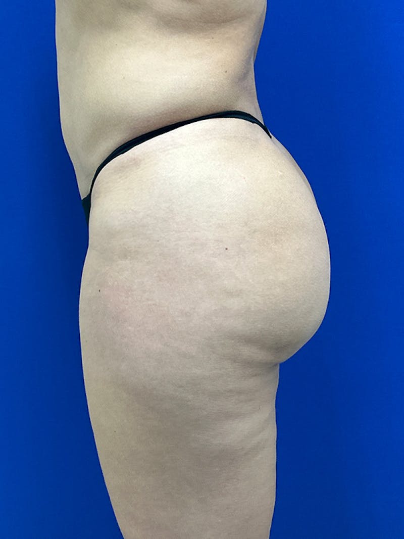 Avéli Cellulite Treatment Before & After Gallery - Patient 427458 - Image 12
