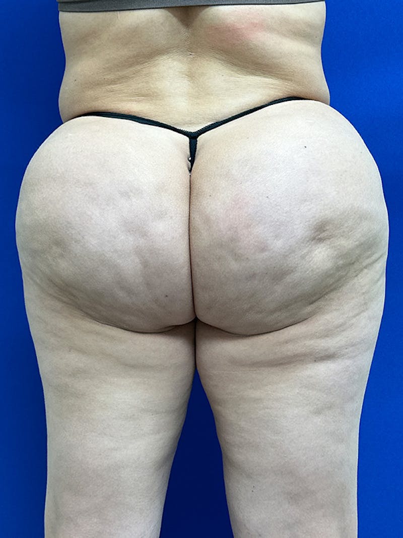 Avéli Cellulite Treatment Before & After Gallery - Patient 427458 - Image 3